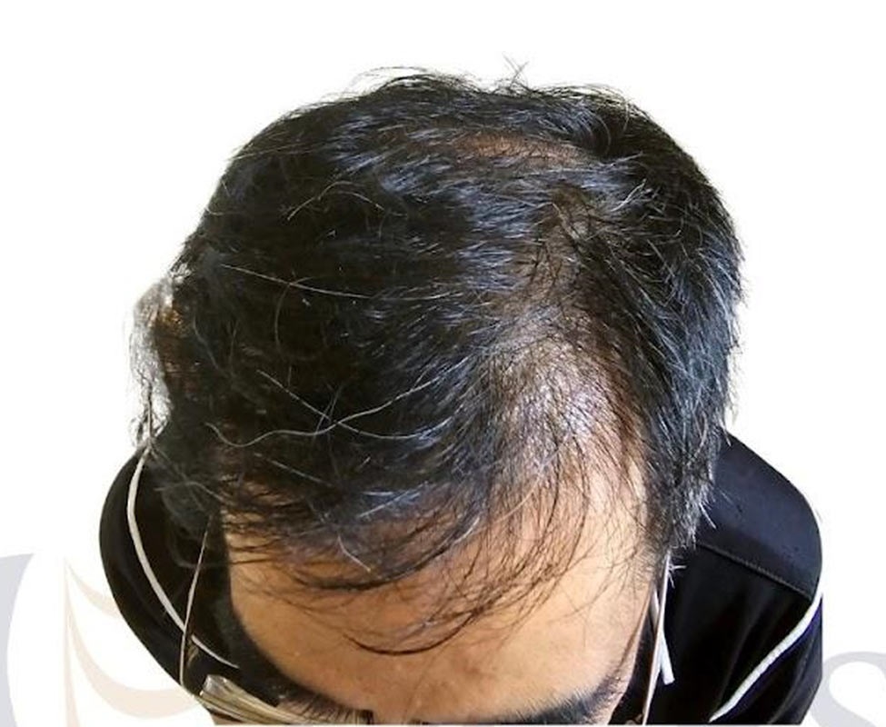 Follicular Unit Extraction (FUE)