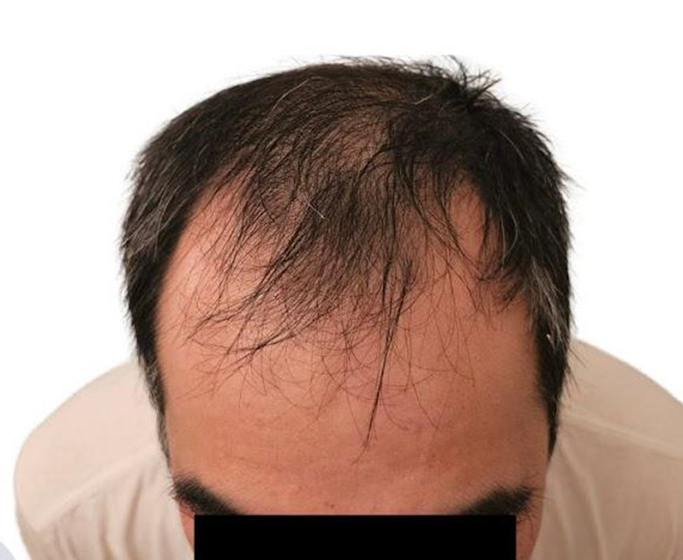 Follicular Unit Extraction (FUE)