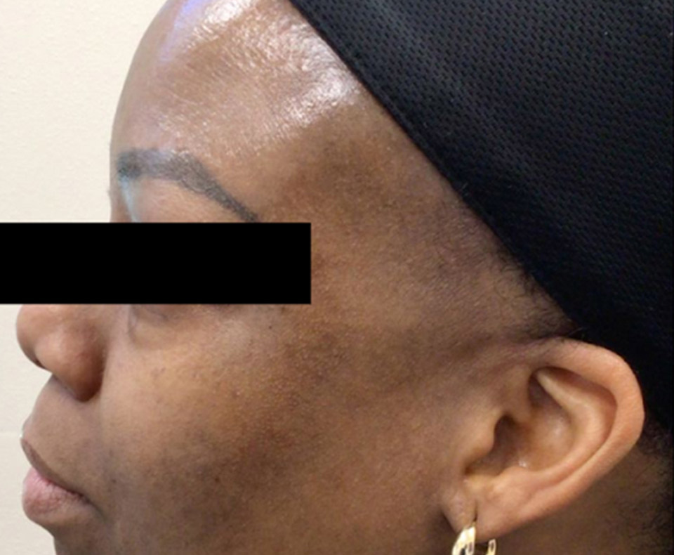 After Hyperpigmentation/Resurfacing: Melanage Chemical Peel 