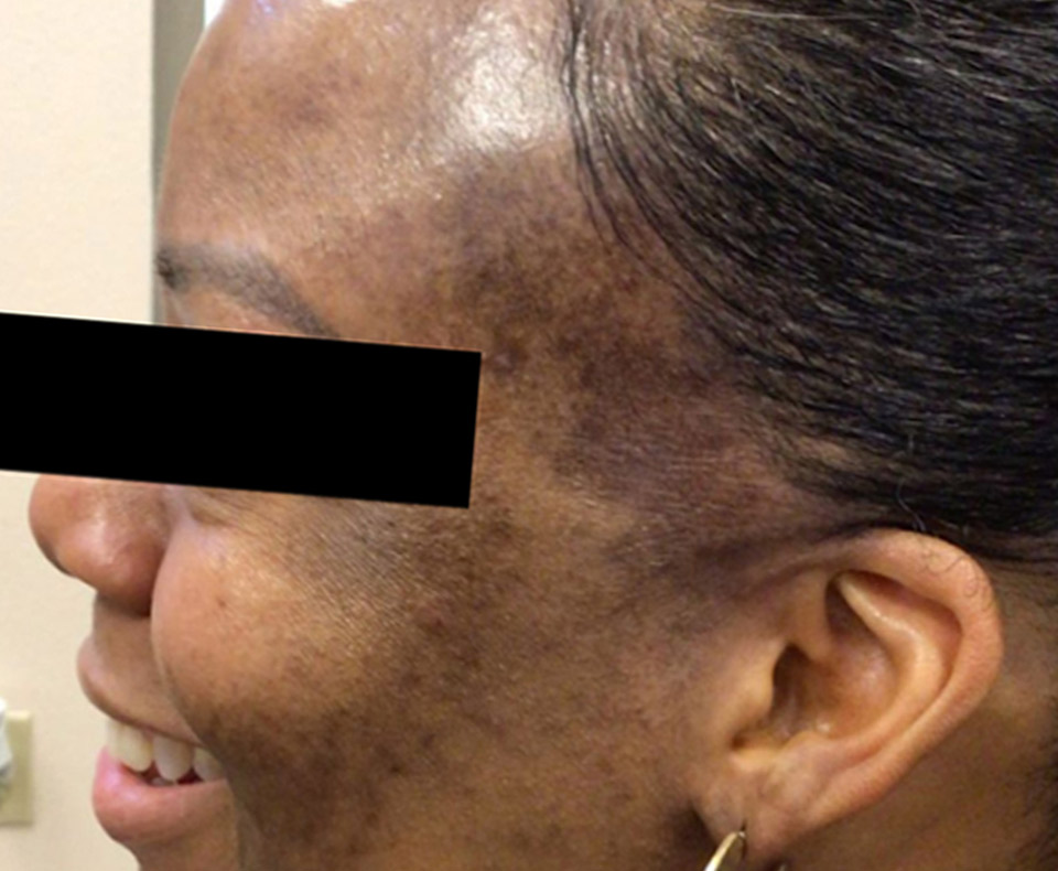 Before Hyperpigmentation/Resurfacing: Melanage Chemical Peel 